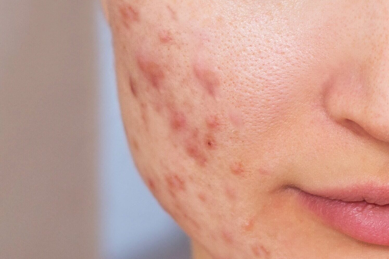 Cropped shot of a young woman's face before and after acne treat