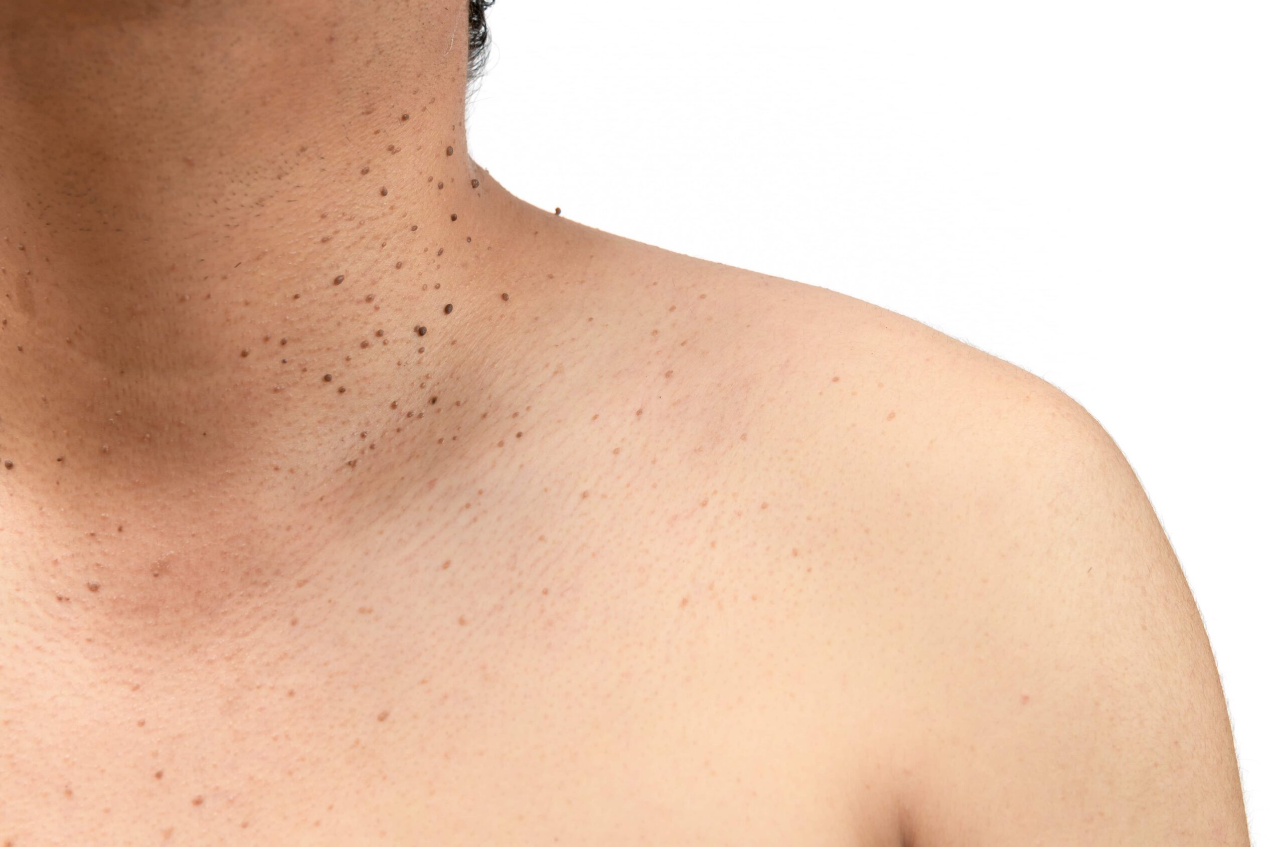 Closed up the skin tags or Seborrheic Keratosis on neck man isolated on white background.Health care concept