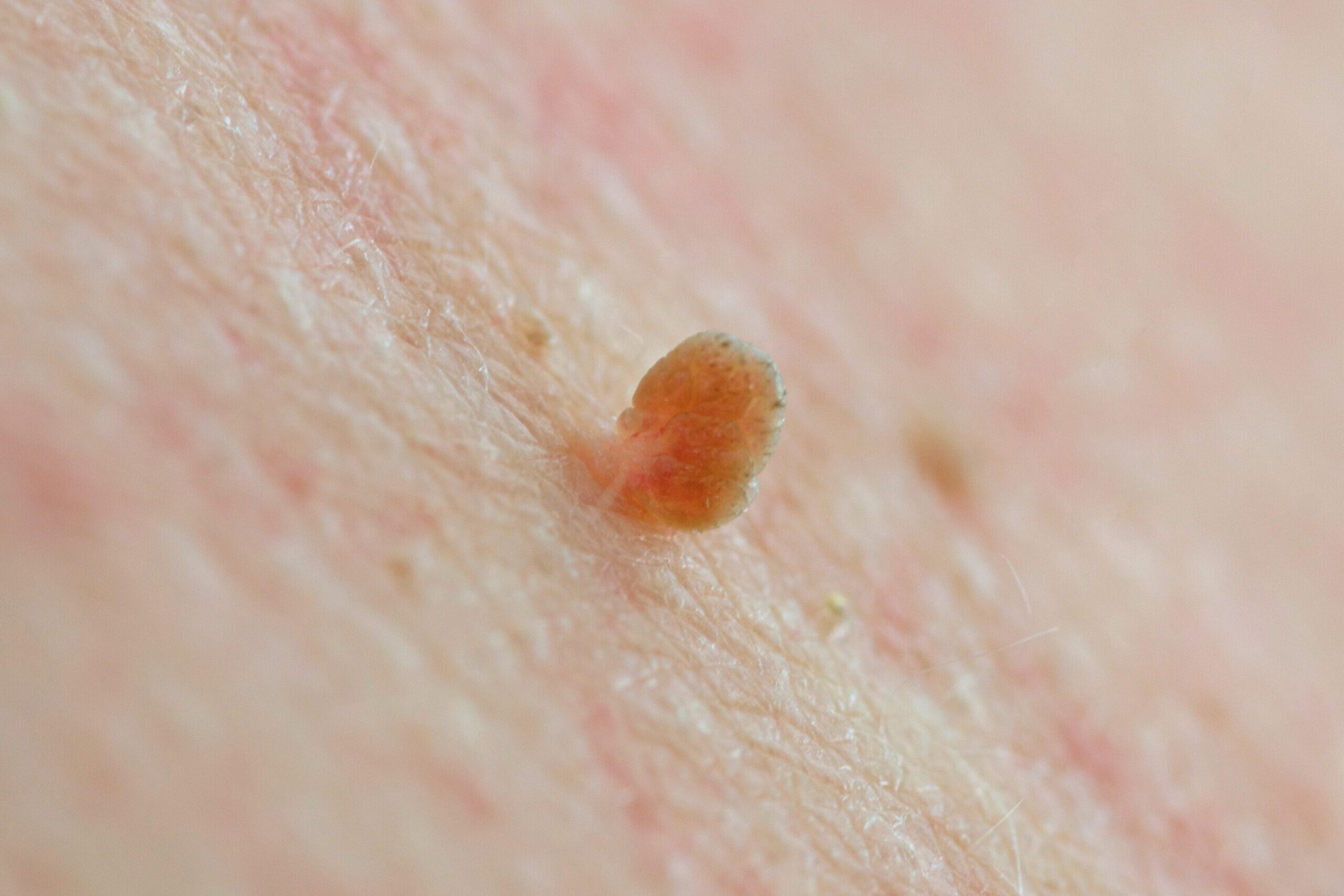 Close up knot skin tag on human skin Caucasian man middle age. I