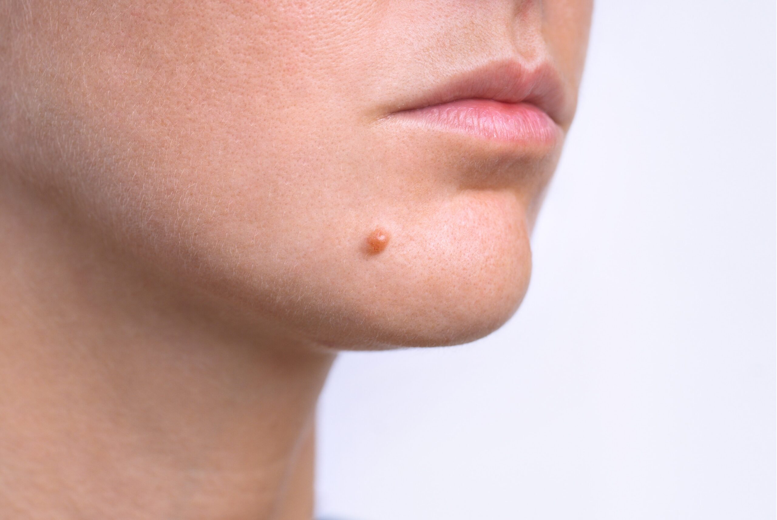 Woman face before and after mole removal. Laser treatment for birthmark removal from patient's face. High quality photo