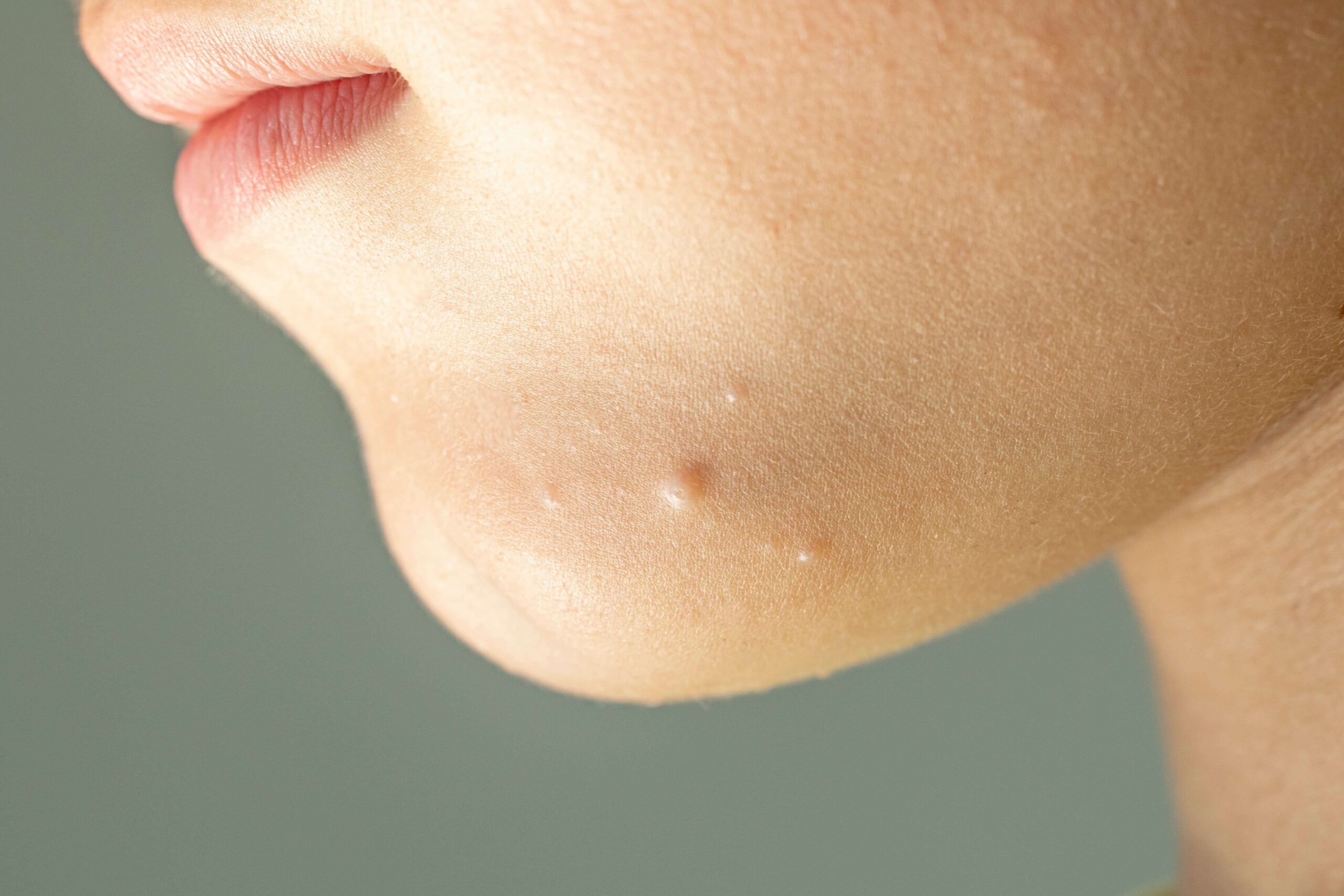 Close-up of Molluscum Contagiosum also called water wart. Viral formations in the chin on the skin of the child. Maternal plaque is in the center and small later rash around. Health care.