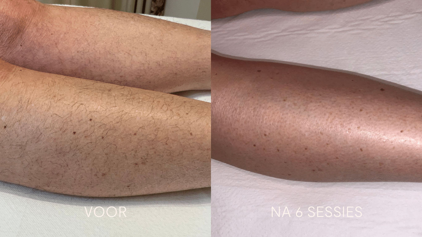 voor_na_sessie_laserontharing5