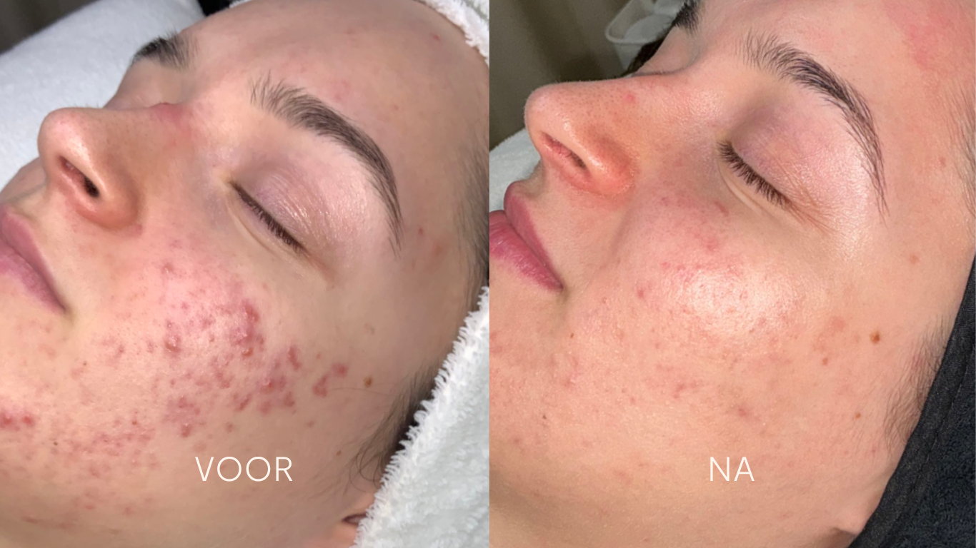 acne_resultaat_blauman_milesman_laser