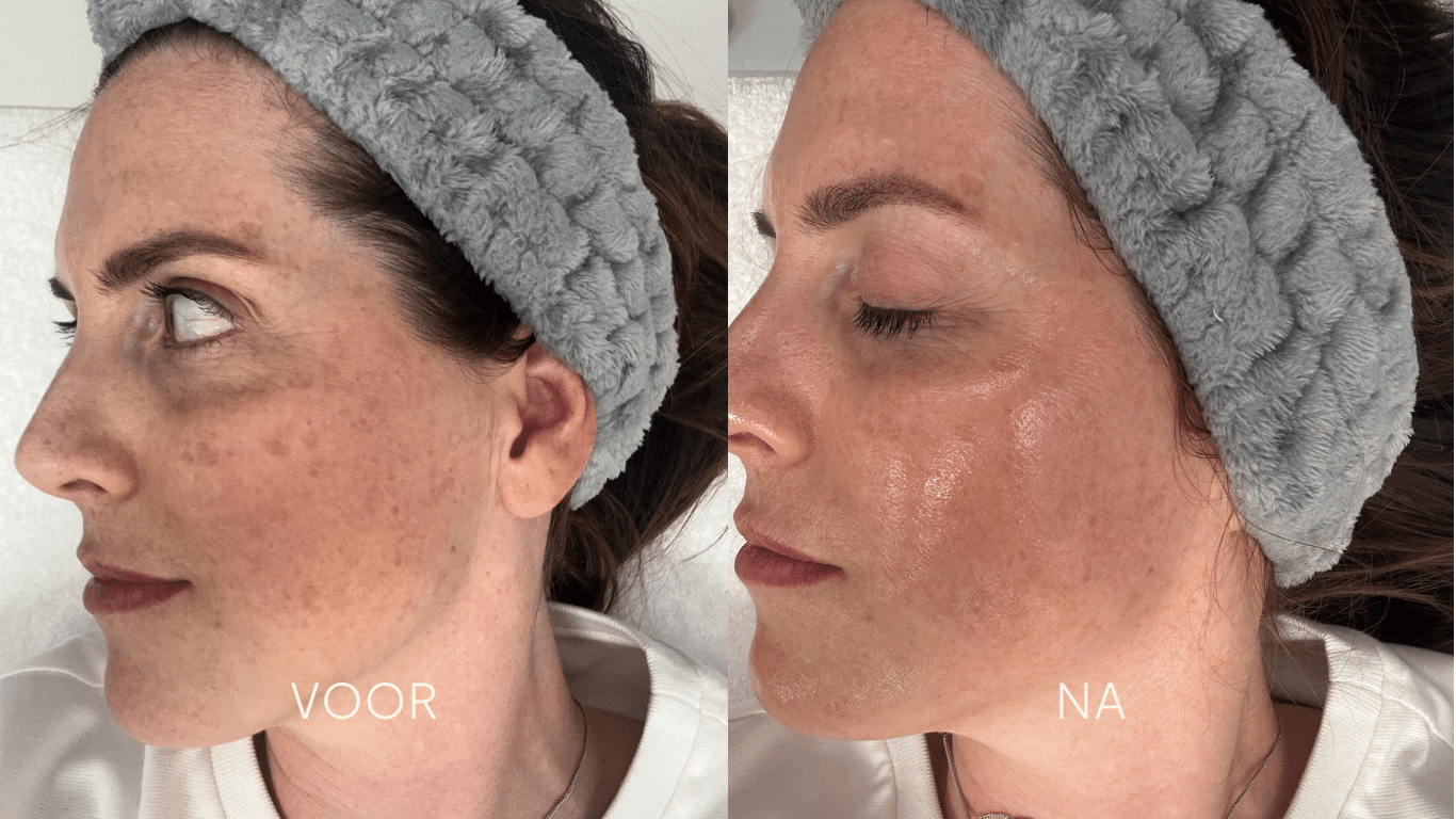 peeling_resultaat_satine_laser (1)